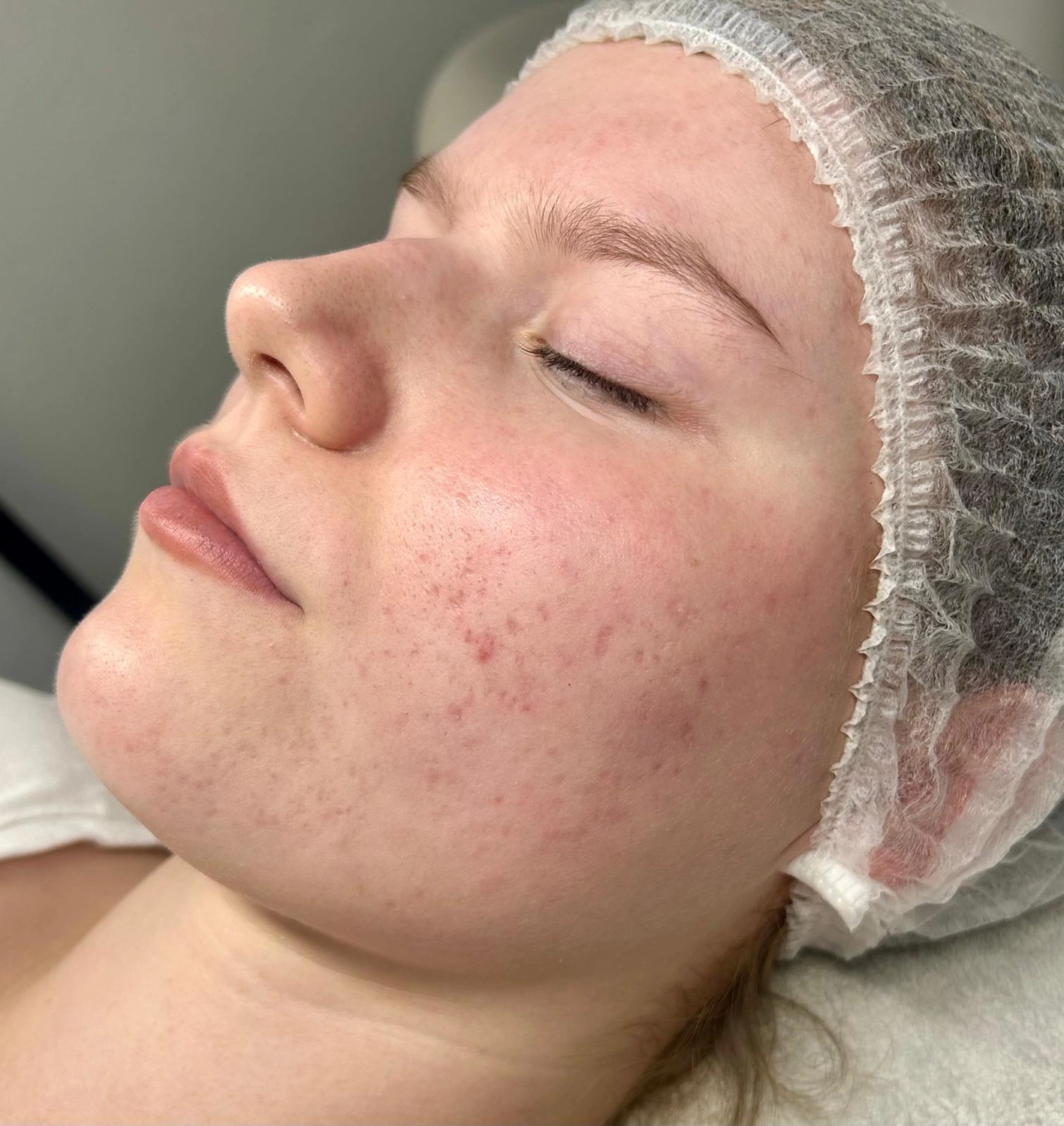 MKS Cosmetics - Phase der Narben – 4 Monate später