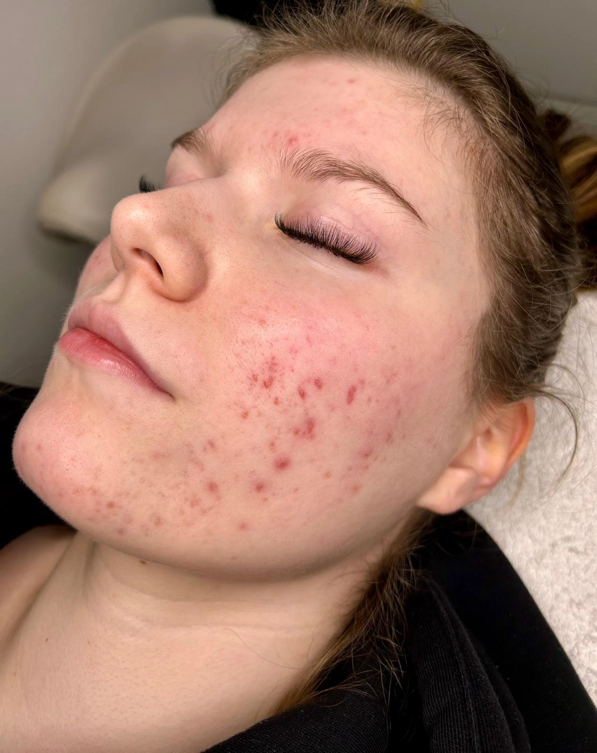 MKS Cosmetics - Erste Verbesserung – 4 Wochen später